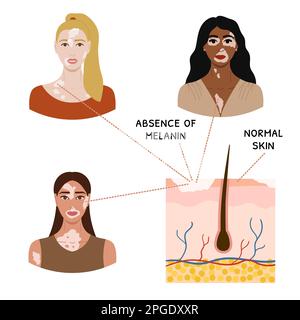 Infografica dei volti femminili con vitiligine. Poster della Giornata Mondiale della Vitiligo. Collezione di ritratti di donne con diversi colori della pelle e acconciature. Corpo Illustrazione Vettoriale