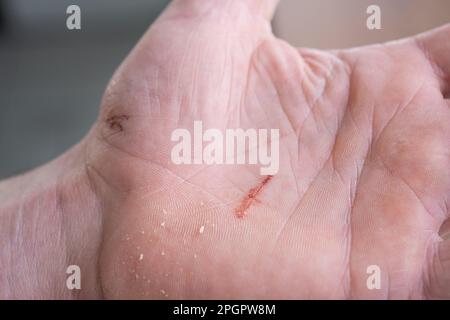 Un taglio sul palmo di un uomo in primo piano. Danni alla pelle della casa con un oggetto tagliente, primo soccorso Foto Stock