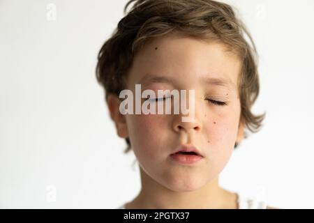 Il ragazzo era gonfio dalle allergie. Allergia da polline o cibo. Foto Stock