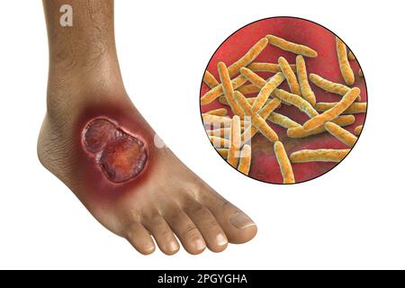 Ulcera di Buruli e Mycobacterium ulcerans, illustrazione Foto Stock