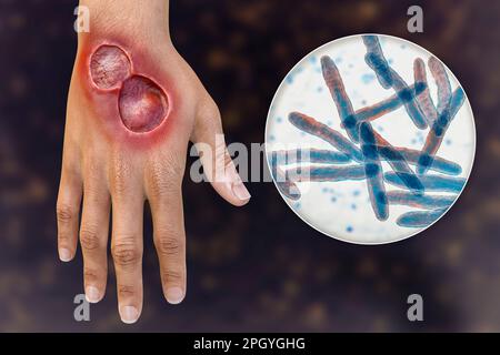 Ulcera di Buruli e Mycobacterium ulcerans, illustrazione Foto Stock