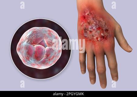 Infezione da prototecosi su una mano umana, illustrazione Foto Stock