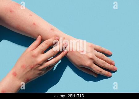 Monkeypox nuova malattia pericolosa in tutto il mondo. Paziente con vaiolo scimmia. Eruzione cutanea dolorosa, macchie rosse sulla mano. Primo piano rash, mani umane con Foto Stock