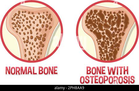 Illustrazione del confronto tra osso normale e osso e osteoporosi Illustrazione Vettoriale