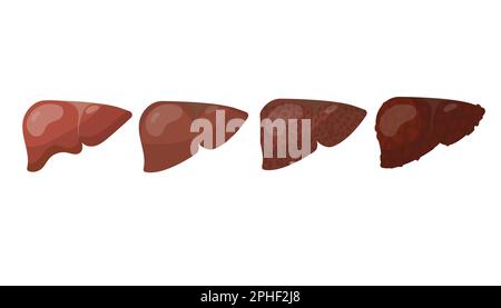 Fasi di distruzione del fegato umano cartoon set di illustrazione Illustrazione Vettoriale