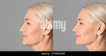 Problema doppio mento. Collage con foto di donna matura prima e dopo la procedura di chirurgia plastica su sfondo grigio, banner design Foto Stock