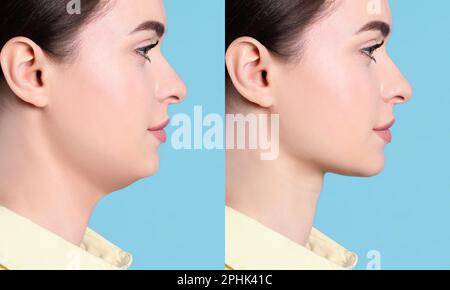 Problema doppio mento. Collage con foto di giovane donna prima e dopo la procedura di chirurgia plastica su sfondo turchese Foto Stock