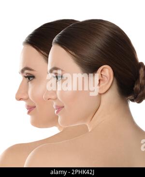 Problema doppio mento. Collage con foto di giovane donna prima e dopo la procedura di chirurgia plastica su sfondo bianco Foto Stock