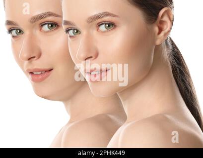 Problema doppio mento. Collage con foto di giovane donna prima e dopo la procedura di chirurgia plastica su sfondo bianco Foto Stock