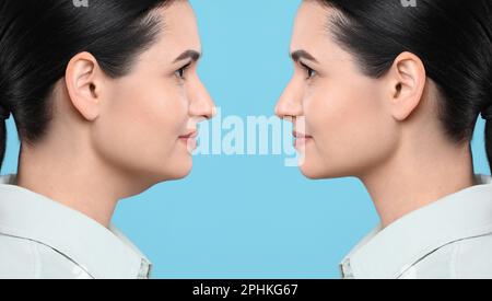 Problema doppio mento. Collage con foto di giovane donna prima e dopo la procedura di chirurgia plastica su sfondo turchese Foto Stock