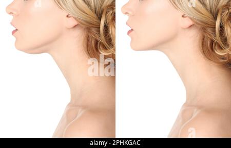 Problema doppio mento. Collage con foto di giovane donna prima e dopo la procedura di chirurgia plastica su sfondo bianco, primo piano Foto Stock