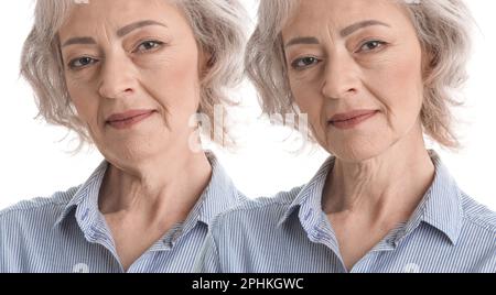 Problema doppio mento. Collage con foto di donna matura prima e dopo la procedura di chirurgia plastica su sfondo bianco Foto Stock