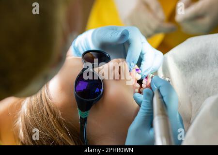 Placca sui denti di colore rosa e viola.collutorio per bambini. Visita dentale. Denti prima e dopo la spazzolatura e lo sbiancamento in una foto. Preventivo Foto Stock