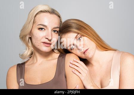 Donna rovesciata con la pelle increckled che appoggia sulla spalla dell'amico con l'acne isolata sull'immagine grigia, di riserva Foto Stock
