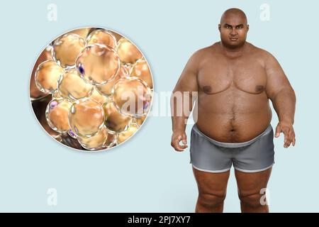 Uomo obeso e cellule grasse, illustrazione Foto Stock