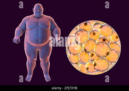 Uomo obeso e cellule grasse, illustrazione Foto Stock