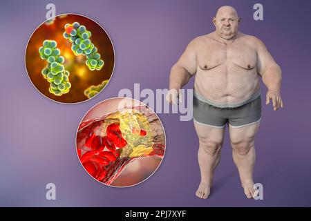 Obesità e aterosclerosi, illustrazione concettuale Foto Stock