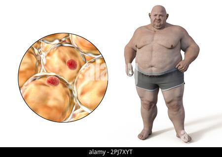 Uomo obeso e cellule grasse, illustrazione Foto Stock