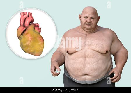 Cuore grasso nell'uomo in sovrappeso, illustrazione. Foto Stock