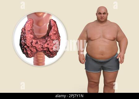 Malattie della tiroide e obesità, illustrazione concettuale Foto Stock