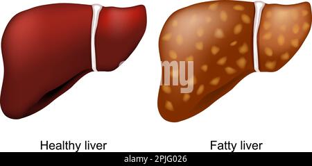steatosi epatica. Fegato sano e steatosi epatica. condizione quando il grasso in eccesso si accumula nel fegato. Illustrazione vettoriale Illustrazione Vettoriale