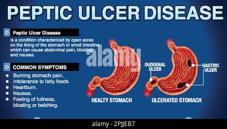 La malattia dell'ulcera peptica ha spiegato l'illustrazione infografica Illustrazione Vettoriale