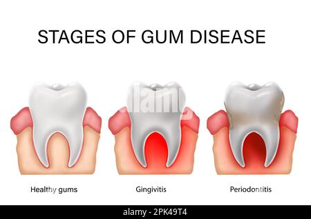 Collage con illustrazioni di denti sani con gengive e quelli infetti che mostrano le fasi della malattia. Gengivite e parodontite Foto Stock