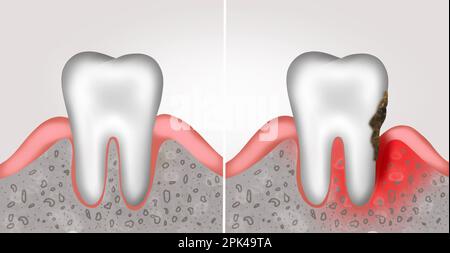 Collage con illustrazioni di denti sani con gengive e malati. Gengivite e parodontite Foto Stock