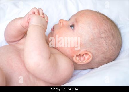 un bambino con segni irritati rossi vicino all'orecchio sinistro e alla guancia, dermatite atopica, vesciche sulla pelle sensibile, un bambino che depone le mani su un panno bianco con la pelle infiammata sul viso, sulla testa, sulla fronte Foto Stock