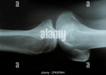 Radiografia di un paziente con un menisco lacerato dell'articolazione del ginocchio in un uomo e diagnosi Foto Stock