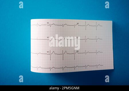 Elettrocardiogramma stampato su carta su un tavolo blu. Foto Stock