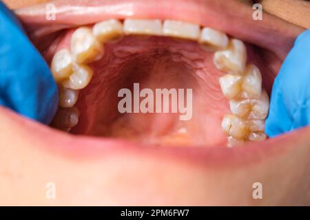Primo piano della mascella superiore, palato duro, palato morbido, denti e gengive di una donna di mezza età. Foto Stock