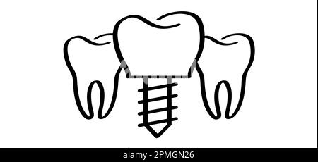 Impianto dentale, medico accurato o ponte dentale. Cartone animato sano, dente con le gengive. Schema della linea molare. Disegno del dente con vite. Danneggiare i denti o Foto Stock