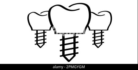 Impianto dentale, medico accurato o ponte dentale. Cartone animato sano, dente con le gengive. Schema della linea molare. Disegno del dente con vite. Danneggiare i denti o Foto Stock