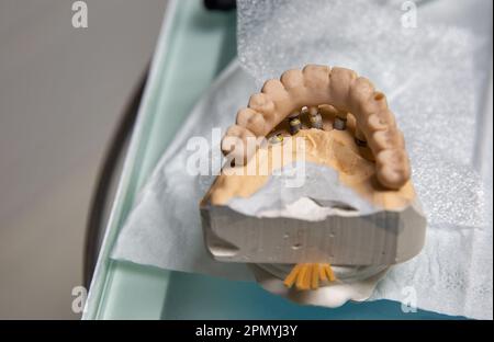 Modello plastico di una protesi dentale permanente ceramica-metallo su impianti di primo piano Foto Stock