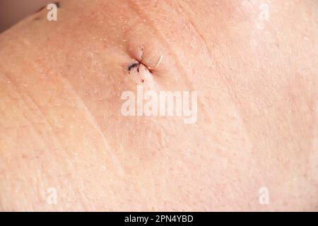 Suture postoperatorie sul ginocchio e sulla gamba inferiore dopo la sostituzione del menisco in un uomo, incisioni cucite Foto Stock