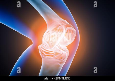 Articolazione umana del ginocchio e ossa con infiammazione, lesione o dolore 3D che rendono illustrazione. Patologia o malattia articolare, anatomia, osteologia, reumatismo Foto Stock