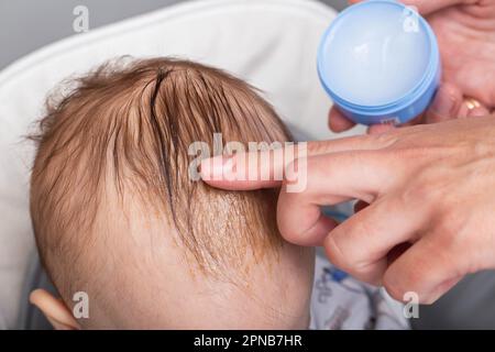 Applicare una crema e un olio speciali al cuoio capelluto del bambino per rimuovere gli sneiss o la crosta seborroica. Scale gialle sul cuoio capelluto. Foto Stock