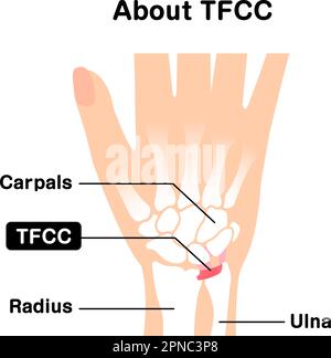 Informazioni sull'illustrazione del vettore TFCC Illustrazione Vettoriale