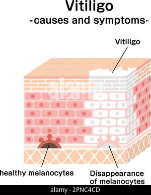 Cause e sintomi di Vitiligo vettore illustrazione Illustrazione Vettoriale