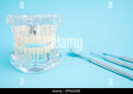 Modello di protesi mascellari o acriliche con impianti e attrezzi dentali su sfondo blu. Foto Stock