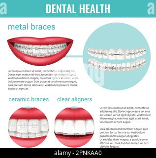 Infografica sulla salute dentale con bretelle in metallo e ceramica realistica illustrazione vettoriale Illustrazione Vettoriale