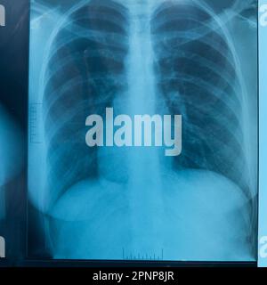 Analisi dei raggi X dei polmoni umani, il medico esamina le malattie polmonari. Polmonite. Radiazione polmonare isolata su sfondo bianco. Foto Stock