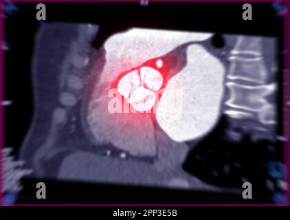 CTA dell'aorta che mostra la valvola aortica. Foto Stock