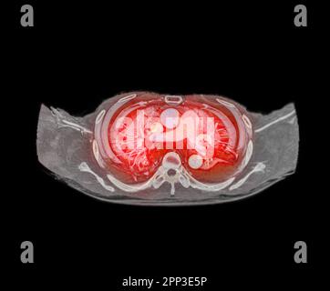 Rappresentazione delle arterie polmonari CTA 3D che mostra il ramo dell'arteria polmonare Foto Stock