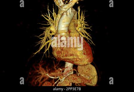 CTA dell'aorta con innesto con stent in aneurisma aortico addominale del paziente. Foto Stock