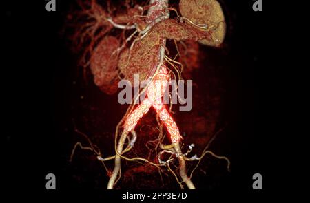 CTA dell'aorta con innesto con stent in aneurisma aortico addominale del paziente. Foto Stock