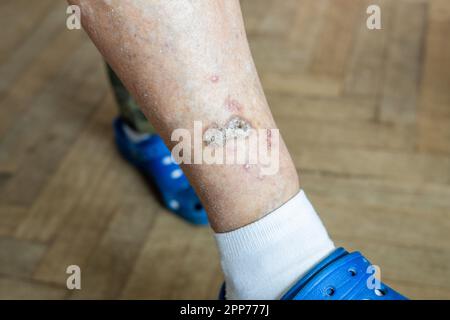 Ulcere e malattie della pelle, secchezza e ferite fresche sulle gambe di una donna anziana, concetto di salute, cambiamenti senili, primo piano Foto Stock