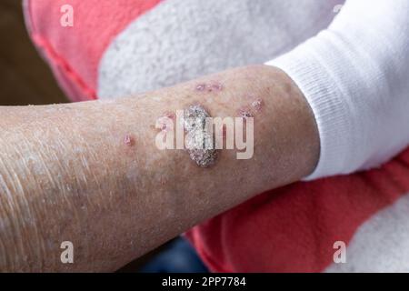 Ulcere e malattie della pelle, secchezza e ferite fresche sulle gambe di una donna anziana, concetto di salute, cambiamenti senili, primo piano Foto Stock