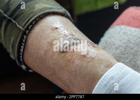 Ulcere e malattie della pelle, secchezza e ferite fresche sulle gambe di una donna anziana, concetto di salute, cambiamenti senili, primo piano Foto Stock